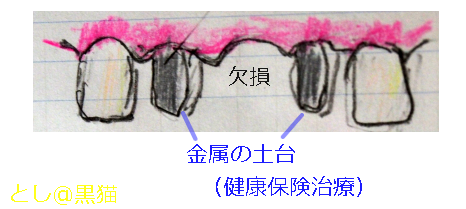 3本ブリッジの差し歯の土台（金属）