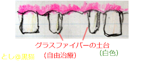 グラスファイバーの土台（ファイバーコア）