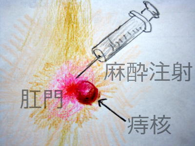 肛門近くにできた痔核