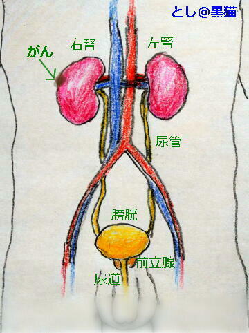 腎細胞がん 腎部分切除手術の日でした