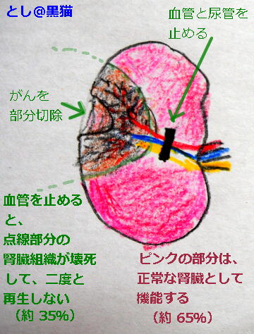 腎細胞がん 術後6ヶ月検査結果 良かった