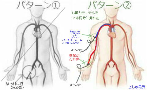 心臓カテーテル検査