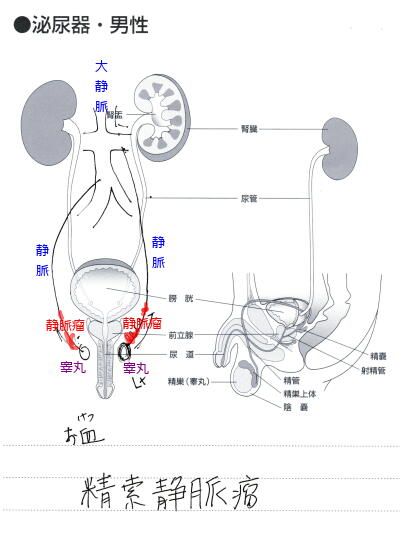 精索静脈瘤