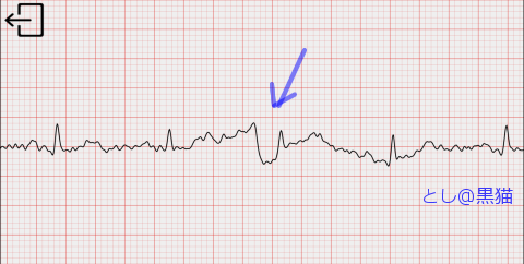 心電図とったら、不整脈
