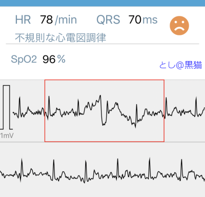 心電図とったら、不整脈