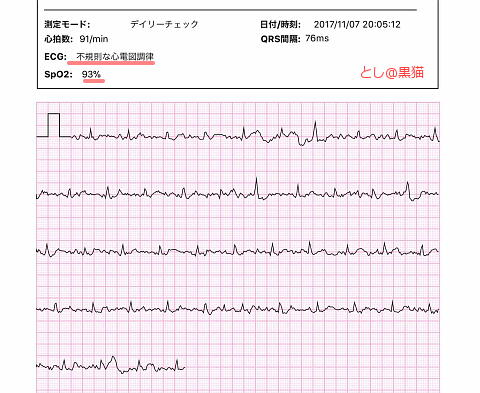 IMG_全て異常な心電図