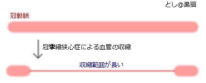 冠攣縮狭心症（異形狭心症）って、なに？