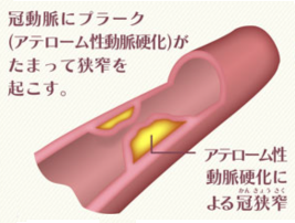 冠攣縮狭心症（異形狭心症）って、なに？